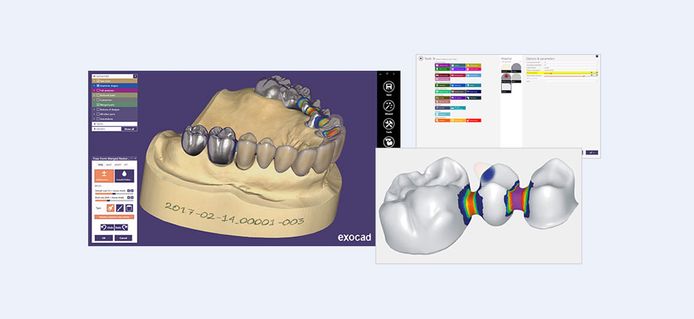 歯科用CADソフト exocad デジタル歯科の未来がここに